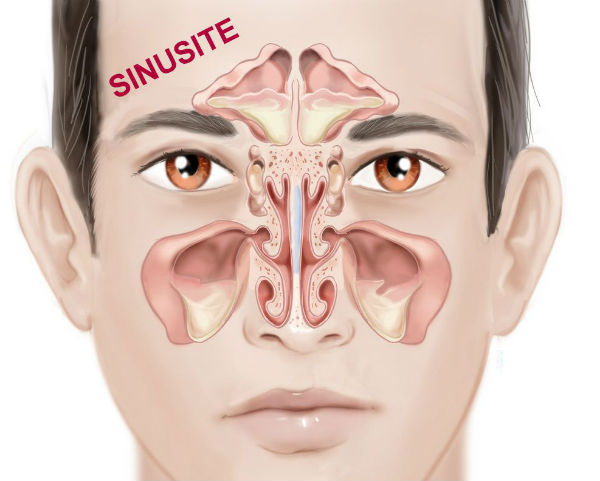 Sinusite: sintomas, o que é, remédios, tratamento